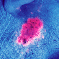 Basalzellkrebs unter dem rechten Ohr - Fluoreszenzbild