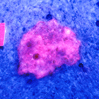 Basalzellkrebs am Dekolleté - Fluoreszenzbild